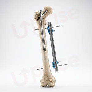 LON limb lengthening method illustration