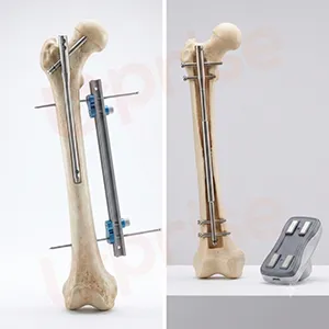 Hybrid limb lengthening method illustration